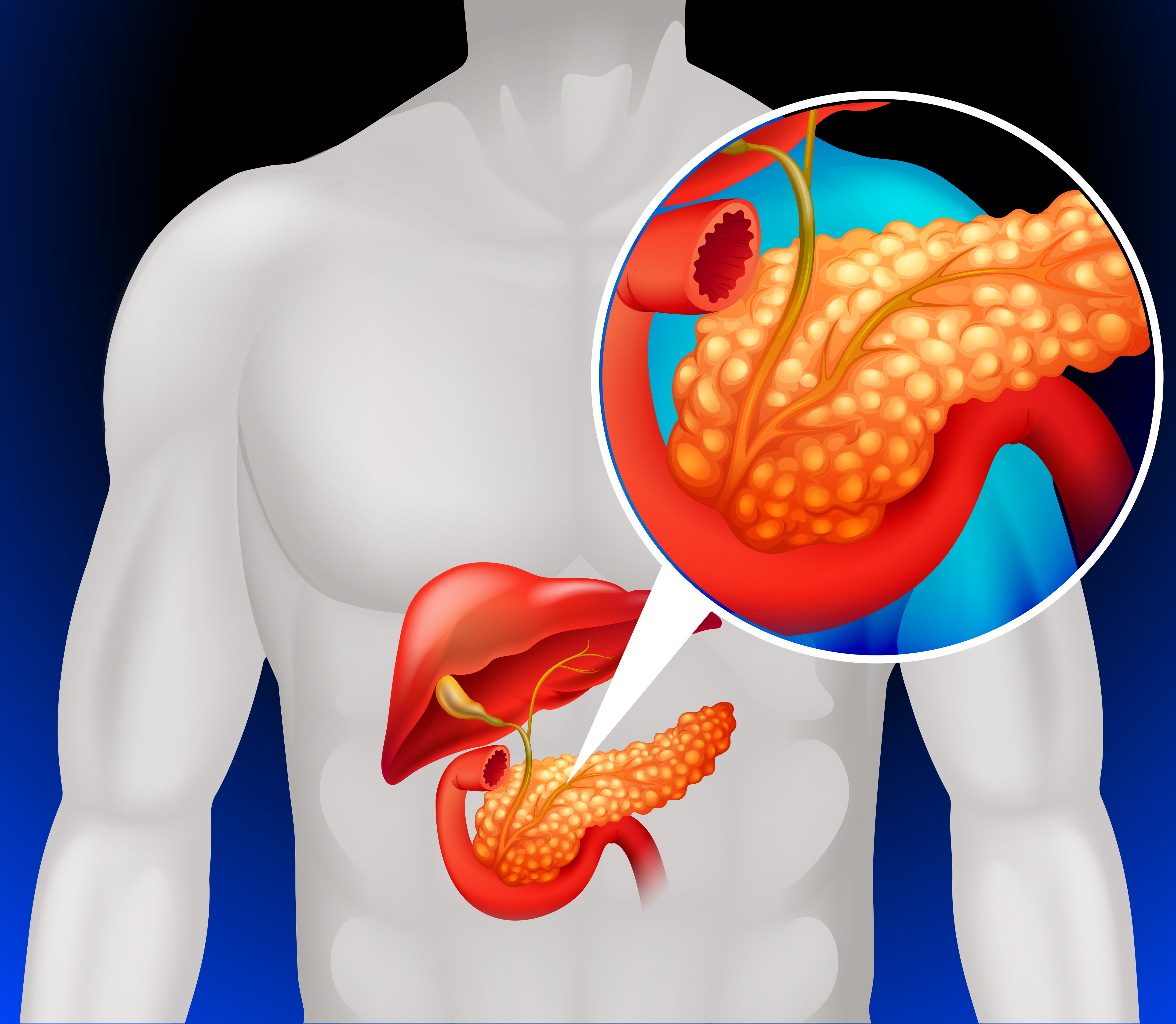 Pancreatite | Endoscopia