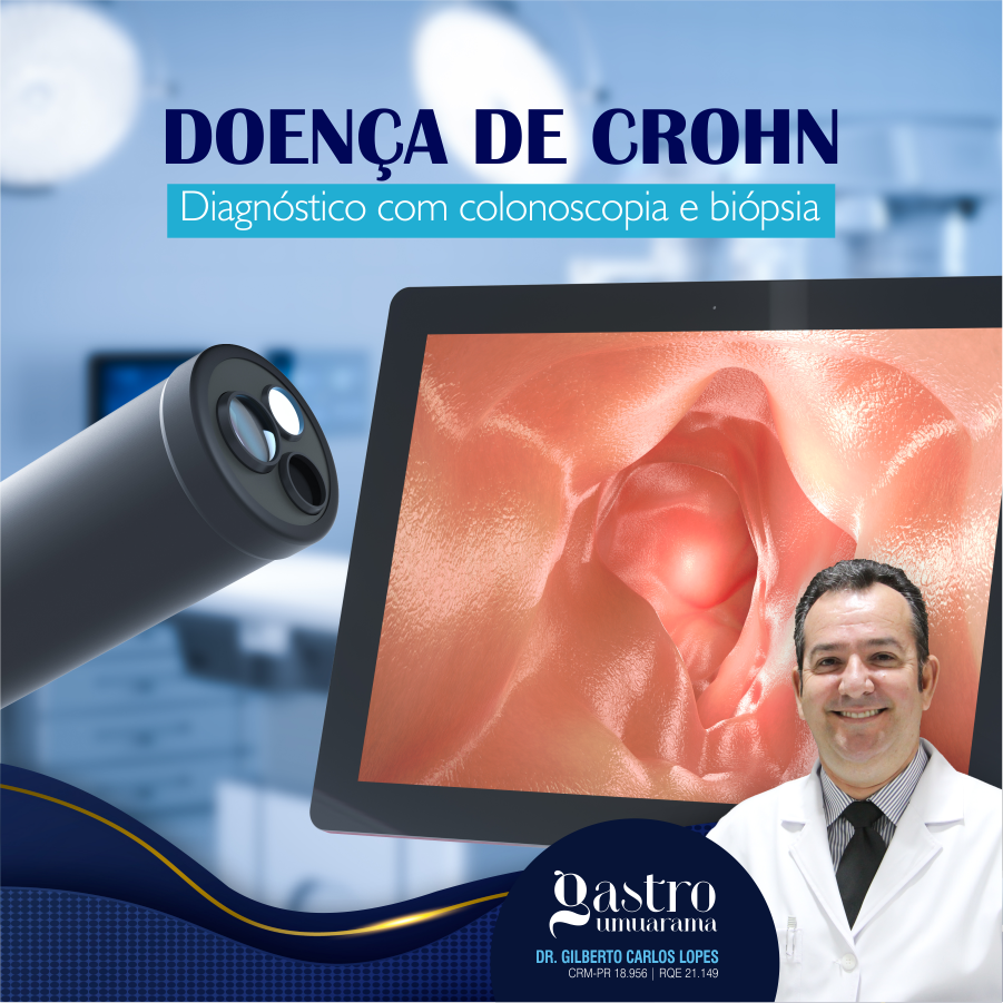 Doença de Crohn | Colonoscopia e Biópsia