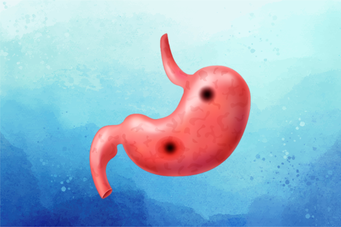 Úlcera Gástrica | Conheça os Principais Sintomas